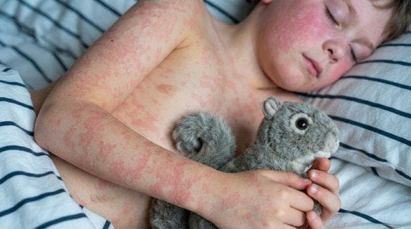 Measles in New York is forcing the state to change who can vaccinate residents