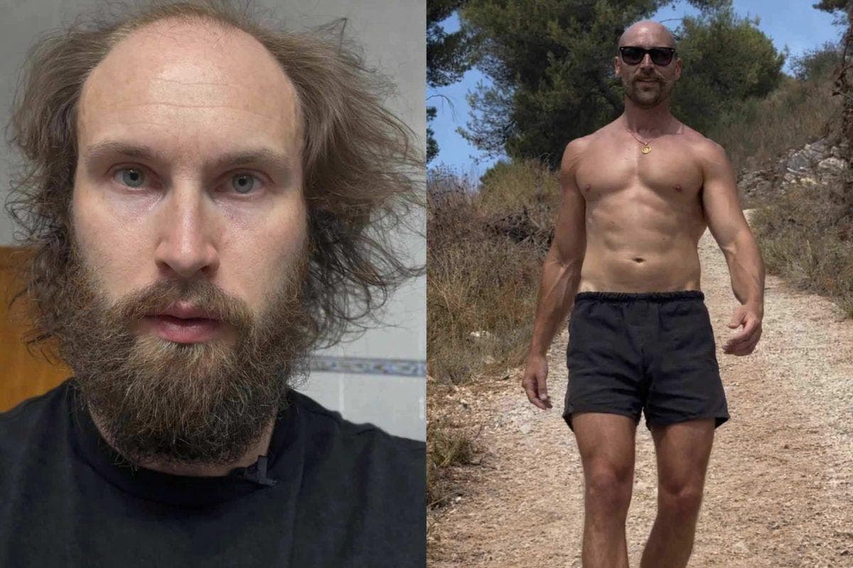 Why ‘Baldmaxxing’ is the new trend burying hair implants