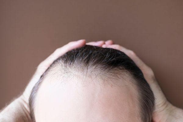 Intermittent fasting may affect hair loss but one key detail was overlooked